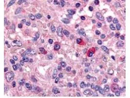 GeneTexs Affinity Purified anti-Artemis antibody was used at a 1:1000 dilution to detect Artemis by immunohistochemistry in human spleen. Positive staining of T cells and B lymphocytes is observed in thymus, lymph nodes and spleen. Tissue was formalin-fixed and paraffin embedded
