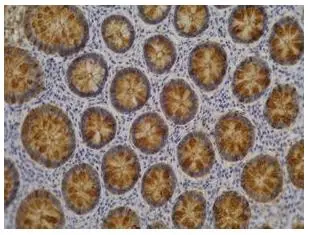 IHC-P analysis of colorectal adenocarcinoma tissue using GTX23967 Blood Group Lewis a antibody [7LE].