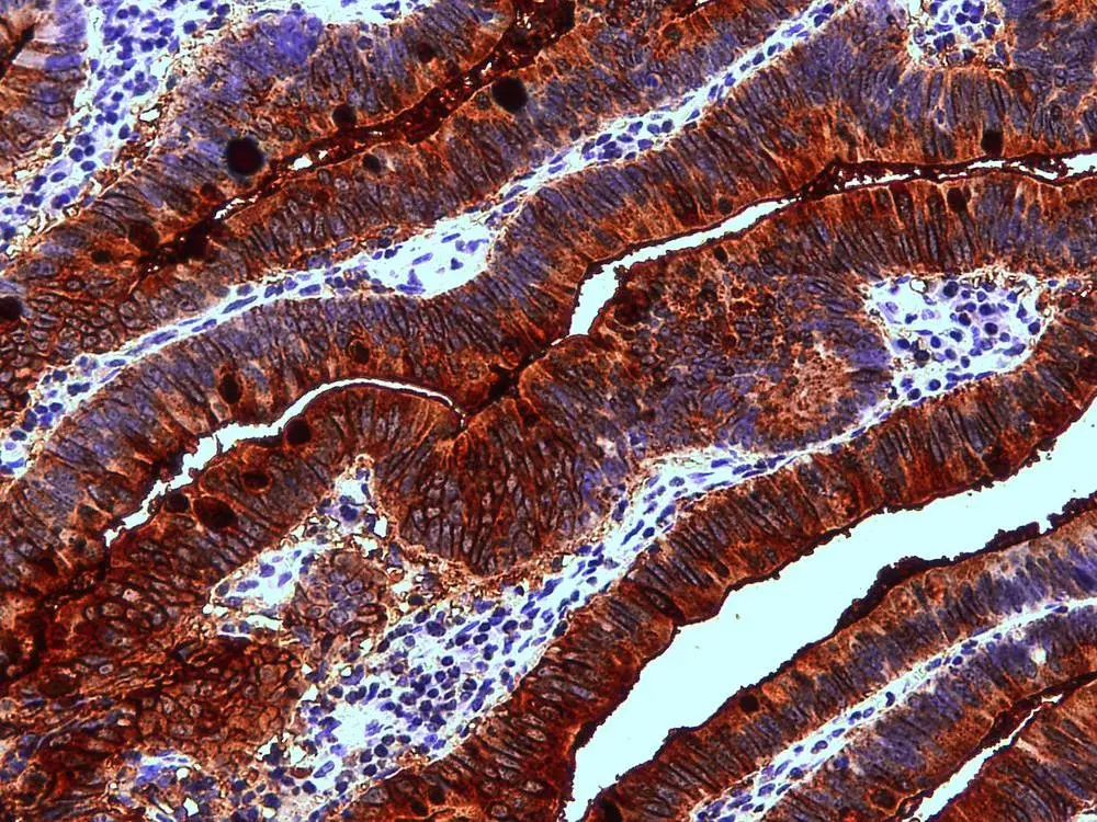 IHC-P analysis of human colon adenocarcinoma tissue using GTX23967 Blood Group Lewis a antibody [7LE].