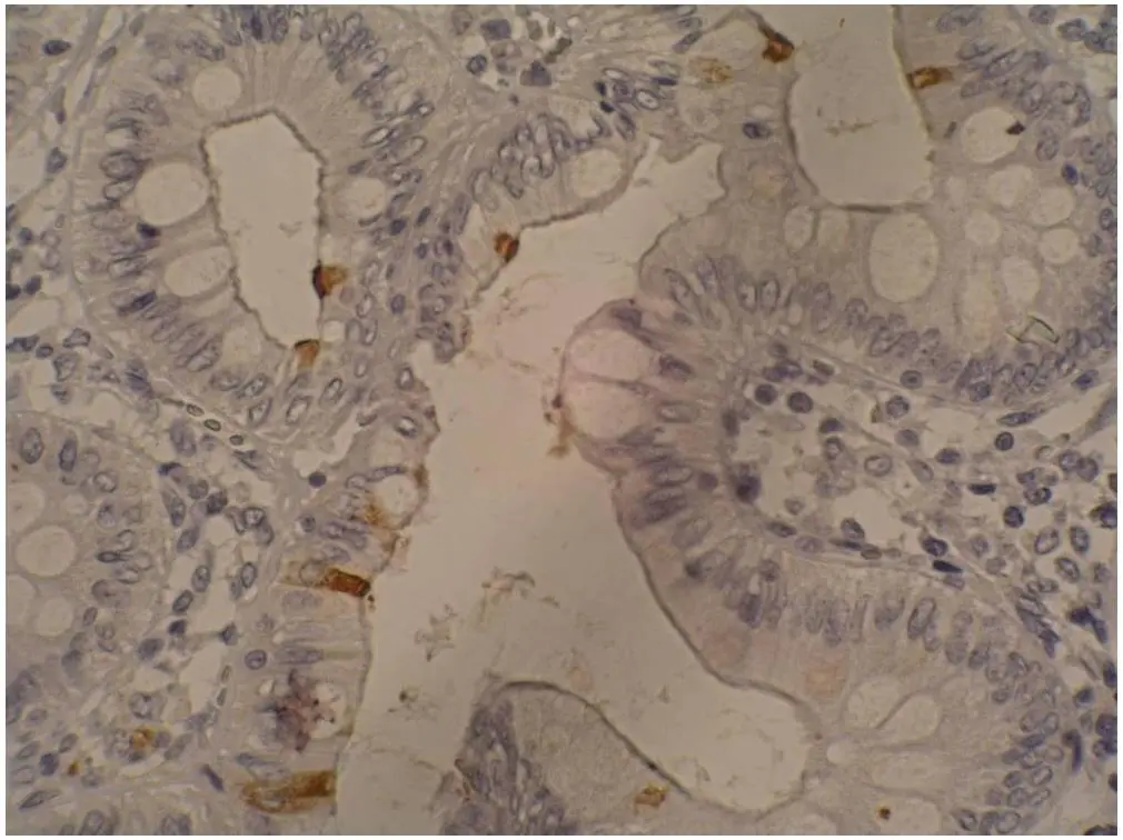 IHC-P analysis of colorectal adenocarcinoma tissue using GTX23982 CA19-9 antibody [121SLE].