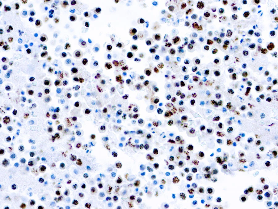 ICC/IF analysis of cultured cells infected with KSHV using GTX24103 KSHV antibody [LN35].