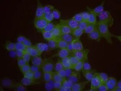 IHC-P analysis of human colon carcinoma tissue using GTX24460 MCM3 antibody. Dilution : 1 ug/ml