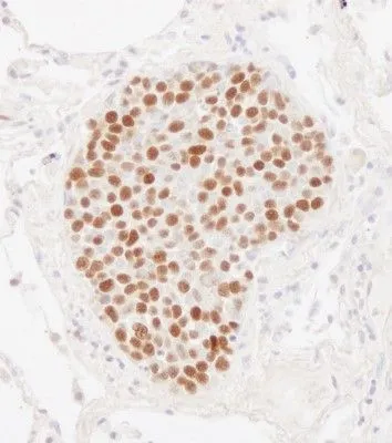 IHC-P analysis of human small cell lung cancer tissue using GTX24461 MCM2 antibody. Dilution : 1 microg/ml