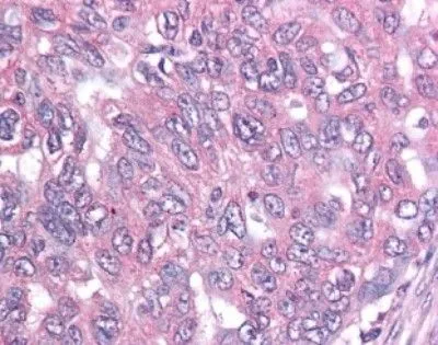 IHC-P analysis of human ovary cancer tissue using GTX24470 Survivin antibody [60.11].