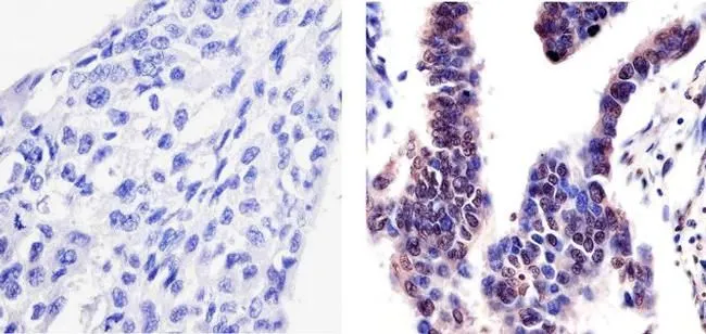 IHC-P analysis of human lung adenocarcinoma tissue using GTX24800 PYK2 (phospho Tyr402) antibody.