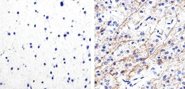 IHC-P analysis of human astroglioma tissue using GTX24856 Tau (phospho Ser262) antibody. Right : Primary antibody Left : Negative control without primary antibody Antigen retrieval : 10mM sodium citrate (pH 6.0), microwaved for 8-15 min Dilution : 1:100 IHC-P analysis of human astroglioma tissue using GTX24856 Tau (phospho Ser262) antibody. Right : Primary antibody Left : Negative control without primary antibody Antigen retrieval : 10mM sodium citrate (pH 6.0), microwaved for 8-15 min Dilution : 1:100