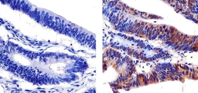 IHC-P analysis of human colon carcinoma tissue using GTX24890 SHC1 (phospho Tyr239/Tyr240) antibody. Right : Primary antibody Left : Negative control without primary antibody Antigen retrieval : 10mM sodium citrate (pH 6.0), microwaved for 8-15 min Dilution : 1:20 IHC-P analysis of human colon carcinoma tissue using GTX24890 SHC1 (phospho Tyr239/Tyr240) antibody. Right : Primary antibody Left : Negative control without primary antibody Antigen retrieval : 10mM sodium citrate (pH 6.0), microwaved for 8-15 min Dilution : 1:20