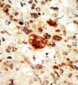 IHC-P analysis of human breast carcinoma using GTX25385 EphA1 antibody.