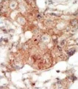 IHC-P analysis of human breast carcinoma using GTX25396 EphA4 antibody.