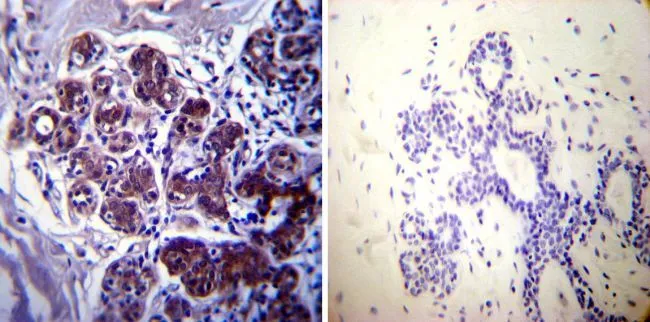 IHC-P analysis of human breast tissue using GTX25444 Hsp70 antibody [4G4]. Left : Primary antibody Right : Negative control without primary antibody Antigen retrieval : heat induced antigen retrieval was performed using 10mM sodium citrate (pH6.0) buffer, microwaved for 8-15 minutes Dilution : 1:50
