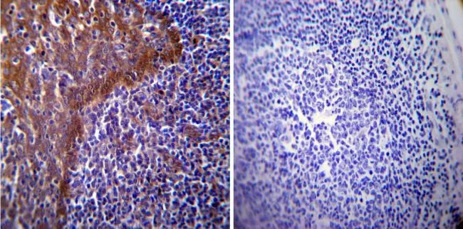 IHC-P analysis of human tonsil tissue using GTX25444 Hsp70 antibody [4G4]. Left : Primary antibody Right : Negative control without primary antibody Antigen retrieval : heat induced antigen retrieval was performed using 10mM sodium citrate (pH6.0) buffer, microwaved for 8-15 minutes Dilution : 1:20