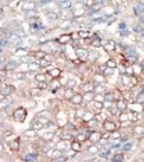 IHC-P analysis of human hepatocarcinoma using GTX25459 PI3-Kinase p150 antibody.