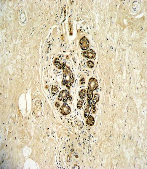 IHC-P analysis of human breast carcinoma using GTX25470 Her3 / ErbB3 antibody.