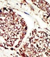IHC-P analysis of human hepatocarcinoma using GTX25470 Her3 / ErbB3 antibody.