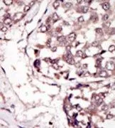 IHC-P analysis of human hepatocarcinoma using GTX25518 RYK antibody.