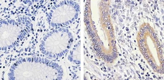 IHC-P analysis of human colon carcinoma tissue using GTX25613 MEK1 (phospho Ser298) antibody. Right : Primary antibody Left : Negative control without primary antibody Antigen retrieval : 10mM sodium citrate (pH 6.0), microwaved for 8-15 min Dilution : 1:100 IHC-P analysis of human colon carcinoma tissue using GTX25613 MEK1 (phospho Ser298) antibody. Right : Primary antibody Left : Negative control without primary antibody Antigen retrieval : 10mM sodium citrate (pH 6.0), microwaved for 8-15 min Dilution : 1:100