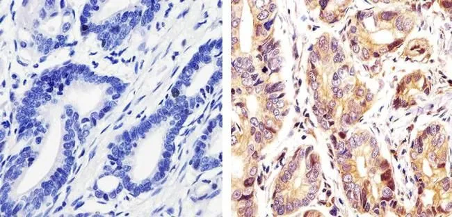 IHC-P analysis of human gastric carcinoma tissue using GTX25633 c-Kit (phospho Tyr730) antibody. Right : Primary antibody Left : Negative control without primary antibody Antigen retrieval : 10 mM sodium citrate (pH 6.0), microwaved for 8-15 min Dilution : 1:20 IHC-P analysis of human gastric carcinoma tissue using GTX25633 c-Kit (phospho Tyr730) antibody. Right : Primary antibody Left : Negative control without primary antibody Antigen retrieval : 10 mM sodium citrate (pH 6.0), microwaved for 8-15 min Dilution : 1:20
