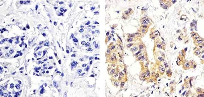 IHC-P analysis of human breast carcinoma tissue using GTX25658 PKC delta (phospho Ser664) antibody. Right : Primary antibody Left : Negative control without primary antibody Antigen retrieval : 10mM sodium citrate (pH 6.0), microwaved for 8-15 min Dilution : 1:20 IHC-P analysis of human breast carcinoma tissue using GTX25658 PKC delta (phospho Ser664) antibody. Right : Primary antibody Left : Negative control without primary antibody Antigen retrieval : 10mM sodium citrate (pH 6.0), microwaved for 8-15 min Dilution : 1:20
