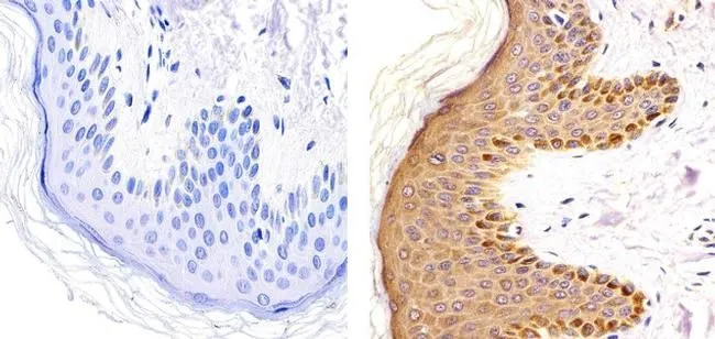 IHC-P analysis of human cerebellum tissue using GTX25778 PKC gamma (phospho Thr514) antibody. Right : Primary antibody Left : Negative control without primary antibody Antigen retrieval : 10 mM sodium citrate (pH 6.0), microwaved for 8-15 min Dilution : 1:20 IHC-P analysis of human cerebellum tissue using GTX25778 PKC gamma (phospho Thr514) antibody. Right : Primary antibody Left : Negative control without primary antibody Antigen retrieval : 10 mM sodium citrate (pH 6.0), microwaved for 8-15 min Dilution : 1:20