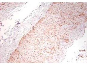 IHC-P analysis of human artery tissue using GTX26671 TNF alpha antibody. Antigen retrieval : Heat mediated citrate buffer (pH 6.0) Dilution : 1:100 IHC-P analysis of human artery tissue using GTX26671 TNF alpha antibody. Antigen retrieval : Heat mediated citrate buffer (pH 6.0) Dilution : 1:100