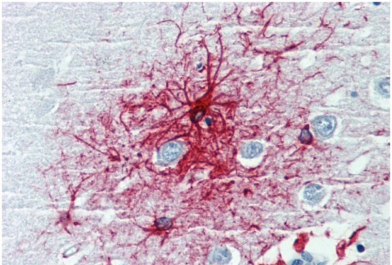 IHC-P analysis of human brain cortex tissue using GTX27806 GFAP antibody [GF-01].