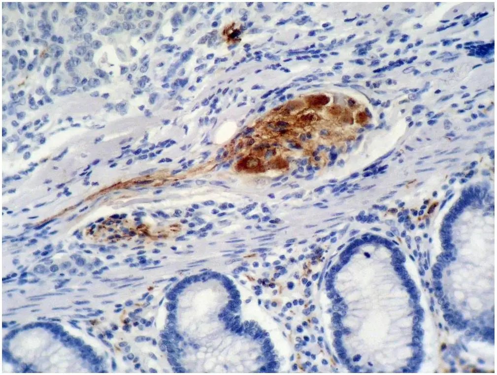 IHC-P analysis of colon carcinoma tissue using GTX27903 p21 Cip1 antibody [WA-1].