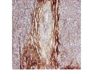 Rabbit anti-Osteopontin (GTX28448) was used at a 1:100-1:300 dilution to detect osteopontin by immunohistochemistry. Osteopontin is a normal component of elastic fibers in the breast (shown heavily stained in this section of human breast tumor cells).