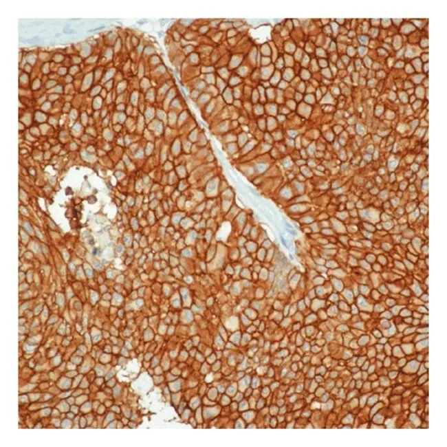 IHC-P analysis of human breast carcinoma tissue using GTX28667 EpCAM antibody [VU-1D9].