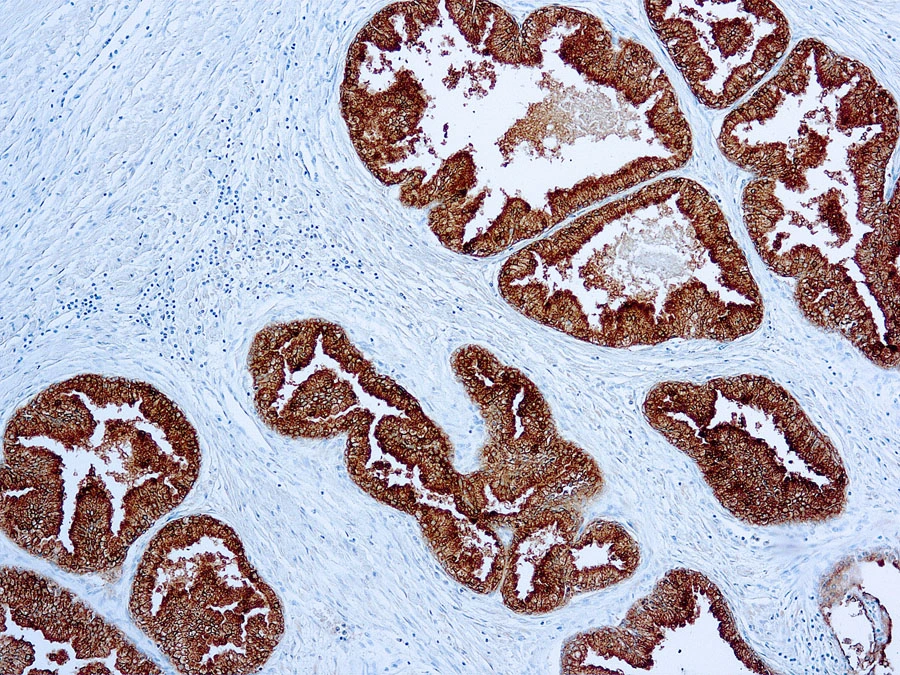 Formalin fixed paraffin embedded human prostate stained with PSAP antibody (cat. # GTX73570).