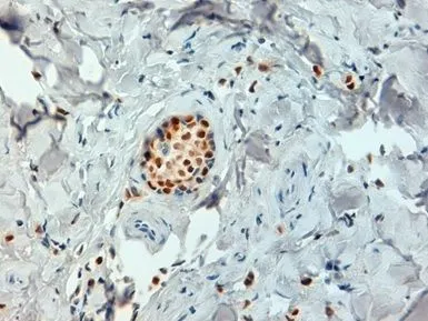 IHC-P analysis of human breast cancer tissue using GTX29269 Estrogen Receptor alpha antibody. Antigen retrieval using citrate buffer at pH6.2. IHC-P analysis of human breast cancer tissue using GTX29269 Estrogen Receptor alpha antibody. Antigen retrieval using citrate buffer at pH6.2.