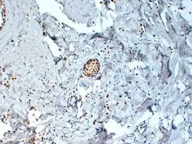 IHC-P analysis of human breast cancer tissue using GTX29269 Estrogen Receptor alpha antibody. Antigen retrieval using citrate buffer at pH6.2.