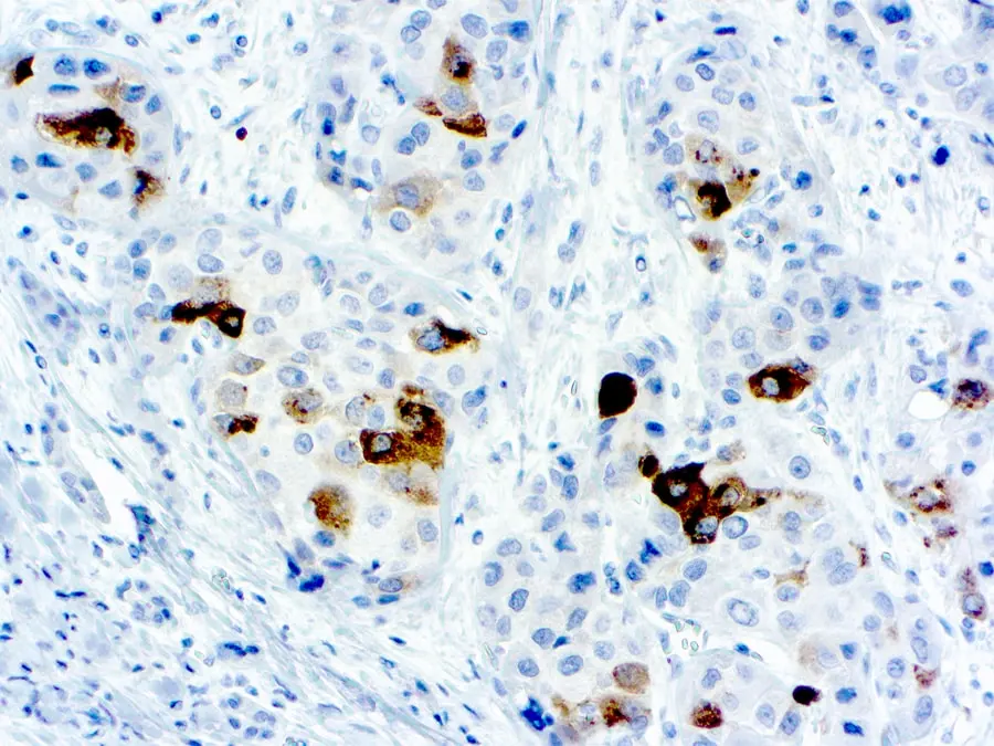 IHC-P analysis of human fetal liver tissue using GTX29372 Alpha fetoprotein / AFP antibody. IHC-P analysis of human fetal liver tissue using GTX29372 Alpha fetoprotein / AFP antibody.