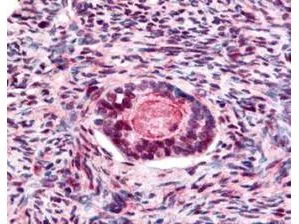 Rabbit anti-GSK3B pS9 (GTX29769) was used at a 1:200 dilution to detect GSK3B by immunohistochemistry in human ovarian cancer tumor tissue. Tissue was formalin-fixed and paraffin embedded. Rabbit anti-GSK3B pS9 (GTX29769) was used at a 1:200 dilution to detect GSK3B by immunohistochemistry in human ovarian cancer tumor tissue. Tissue was formalin-fixed and paraffin embedded.