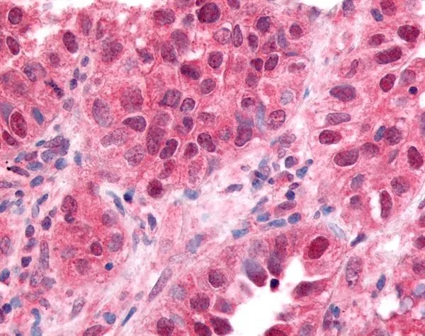IHC-P analysis of human lung small cell carcinoma using GTX30001 EGR1 antibody.