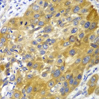 IHC-P analysis of human esophageal cancer tissue using GTX30037 Adenylate kinase 1 antibody. Dilution : 1:100