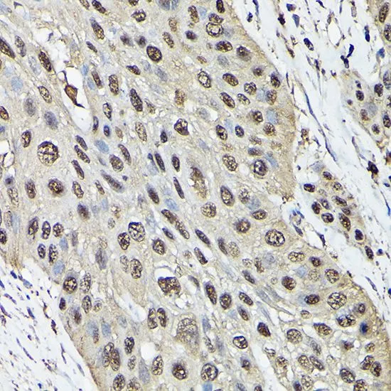 IHC-P analysis of human esophageal cancer tissue using GTX30079 Ataxin 3 antibody. Dilution : 1:100