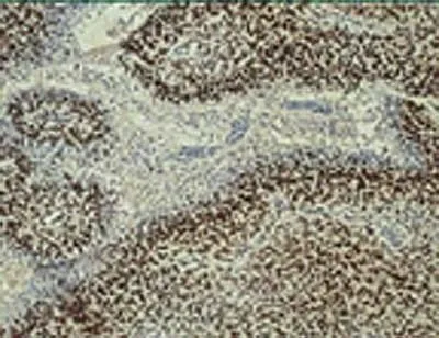 IHC-P analysis of human glioblastoma tissue using GTX30116 HIF1 beta antibody [H1beta234].