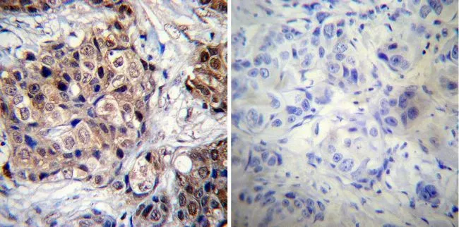 IHC-P analysis of human breast carcinoma tissue using GTX30164 Progesterone Receptor (phospho Ser190) antibody [1154]. Left : Primary antibody Right : Negative control without primary antibody Antigen retrieval : heat induced antigen retrieval was performed using 10mM sodium citrate (pH6.0) buffer, microwaved for 8-15 minutes Dilution : 1:20