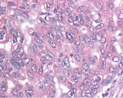 IHC-P analysis of ovary cancer tissue using GTX30241 Survivin antibody [60.11].