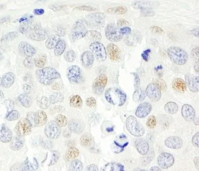 IHC-P analysis of human prostate carcinoma tissue using GTX30433 CDKN2A / p14ARF antibody. Dilution : 1 microg/ml