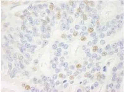 IHC-P analysis of human prostate carcinoma tissue using GTX30434 CDKN2A / p14ARF antibody. Dilution : 1 ug/ml
