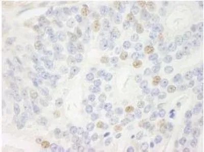 IHC-P analysis of human prostate adenocarcinoma tissue using GTX30434 CDKN2A / p14ARF antibody. Dilution : 1:250