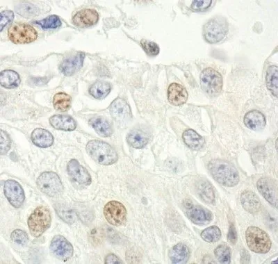 IHC-P analysis of human prostate carcinoma tissue using GTX30434 CDKN2A / p14ARF antibody. Dilution : 1 microg/ml