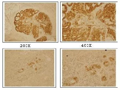 IHC-Fr analysis of human breast carcinoma tissue using GTX30648 DLX4 antibody. TOP : breast cancer tissue Bottom : normal breast tissue