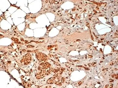IHC-P analysis of human breast cancer biopsy tissue using GTX30725 CD44 antibody [F10-44-2].