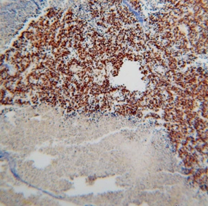 Immunohistochemical of paraffin-embedded human lung cancer using GTX30809 (TARDBP antibody) at dilution of 1:100 (under 10x lens)