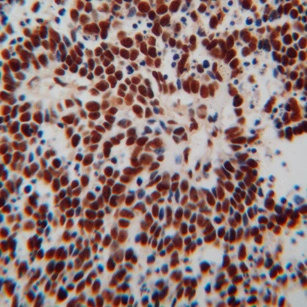 Immunohistochemical of paraffin-embedded human lung cancer using GTX30809 (TARDBP antibody) at dilution of 1:100 (under 40x lens)