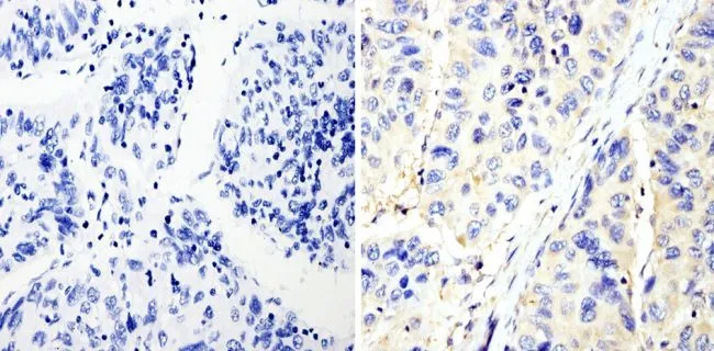IHC-P analysis of human hepatocarcinoma tissue using GTX31144 RhoA + RhoC antibody [1B3-4A10]. Right : Primary antibody Left : Negative control without primary antibody Antigen retrieval : 10mM sodium citrate (pH 6.0), microwaved for 8-15 min Dilution : 1:200