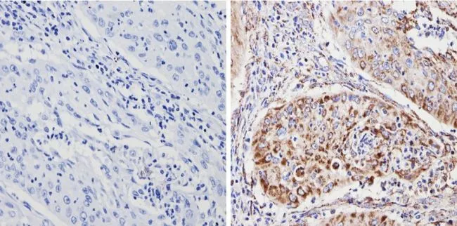 IHC-P analysis of human cervical carcinoma tissue using GTX31147 SOD2 antibody [1H6]. Right : Primary antibody Left : Negative control without primary antibody Antigen retrieval : 10mM sodium citrate (pH 6.0), microwaved for 8-15 min Dilution : 1:200