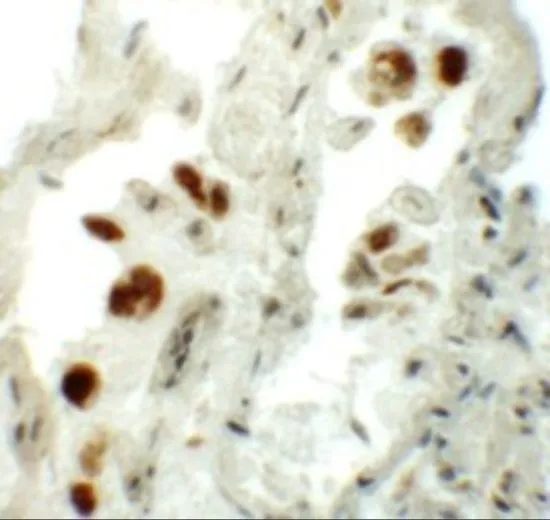 IHC-P analysis of human lung tissue using GTX31439 NUMB antibody. Working concentration : 5 microg/ml IHC-P analysis of human lung tissue using GTX31439 NUMB antibody. Working concentration : 5 microg/ml